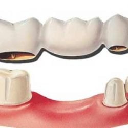 dantų tiltas ant sveikų dantų