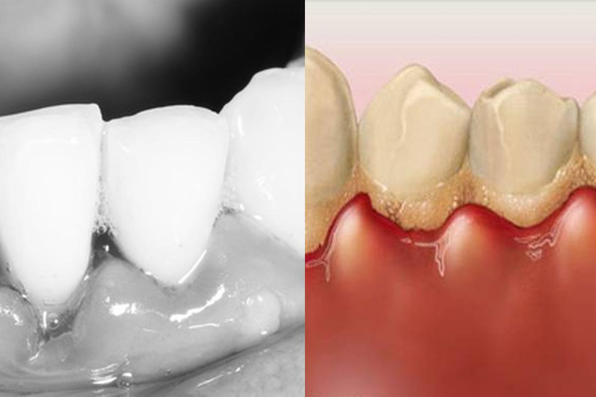 Dantenų uždegimo požymiai įvairūs: patinę dantys, pakitusi spalva, kietėjimas ir kita