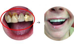 Kompleksinė problema reikalaujanti paradantozės gydymo, dantų protezų ir implantavimo
