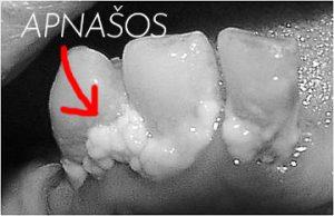 Apna&scaron;os - viena dantenų uždegimo priežasčių!