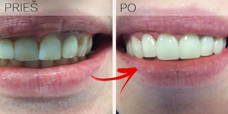 Dantų laminatės ar estetinis protezavimas