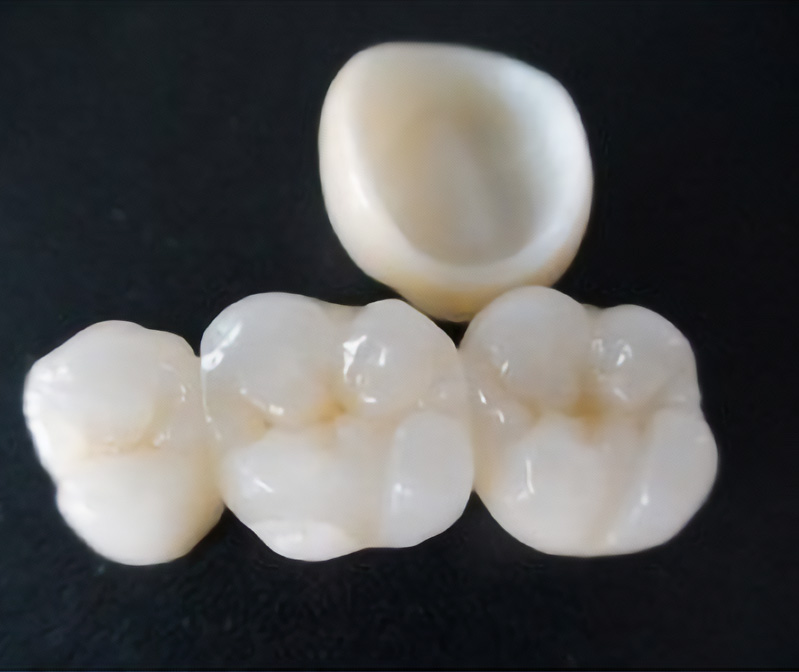 Kuo skiriasi cirkonis nuo metalo keramikos?