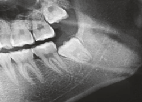 Protinio danties rovimas (&scaron;alinimas) Vilniuje