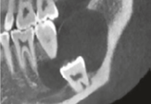 Protinio danties cista