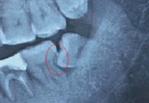 Gretutiniu dantu pazeidimai