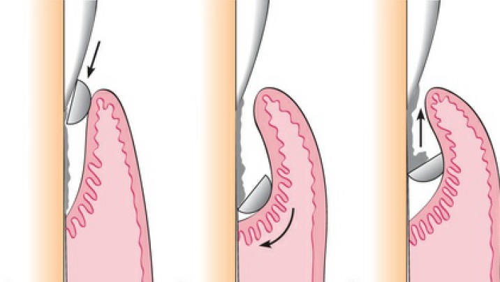 Periodontologas Vilniuje, periodontitas