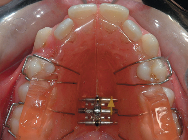Dantų tiesinimas plok&scaron;telėmis