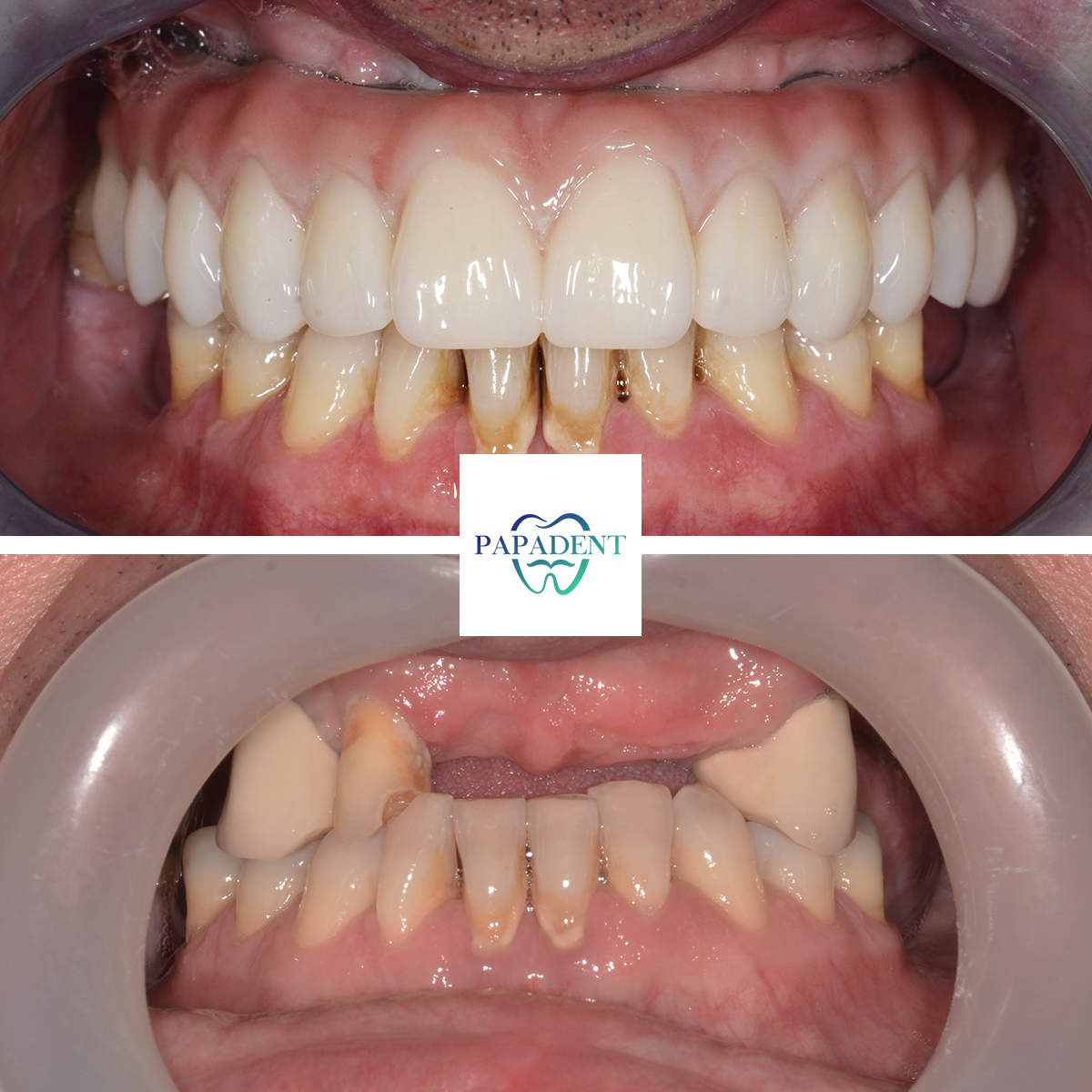 Visi dantys ant 4 implantu pries ir po 1