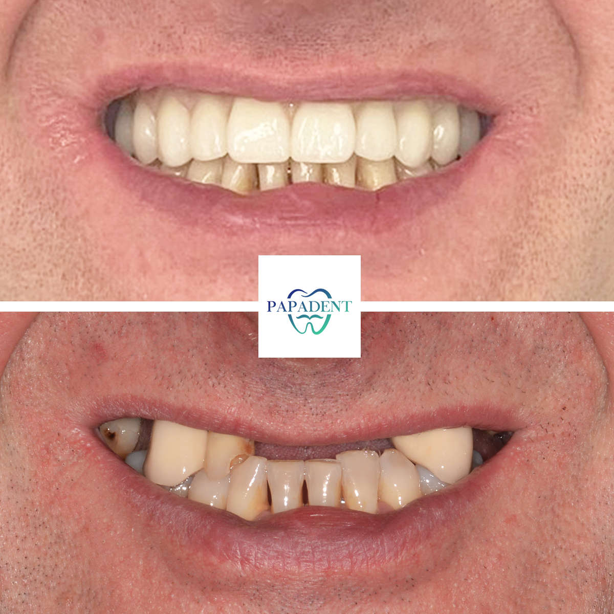 Visi dantys ant 4 implantu pries ir po