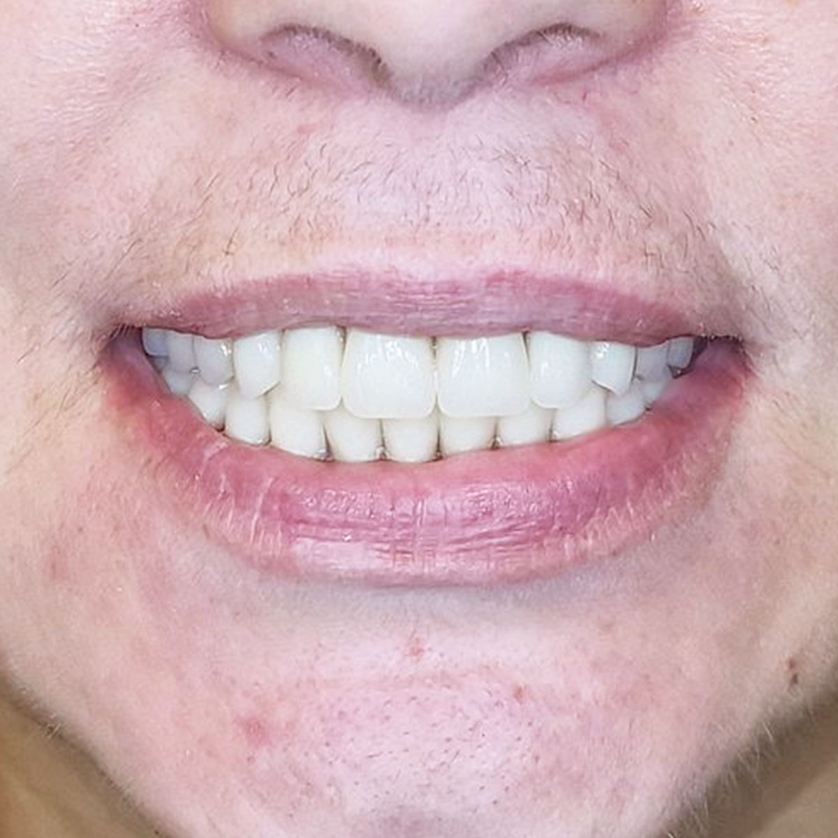 Gintarė - Viso žandikaulio implantacijos atvejis