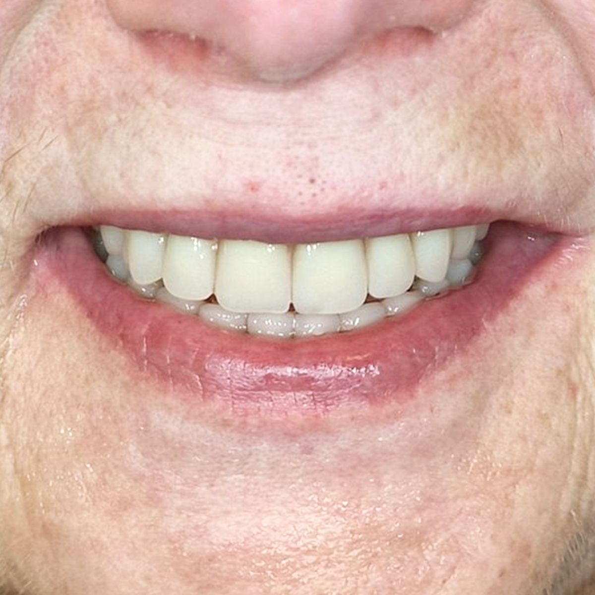 Natalijos sypsena po all on 4 proceduros