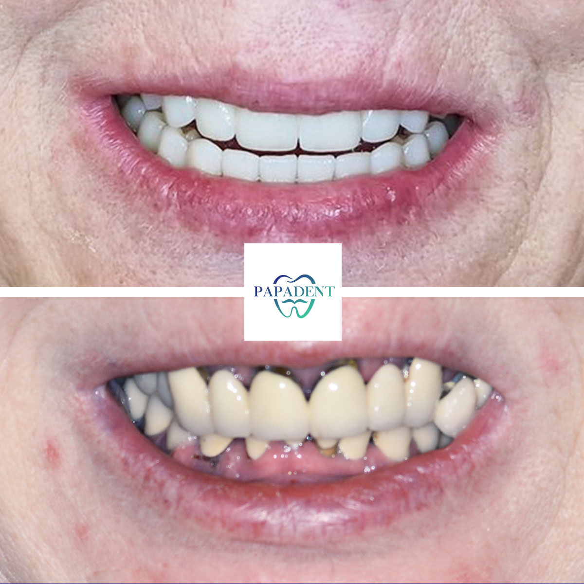 Vitalija - Visi dantys ant keturių impantų - Prieš ir po 2