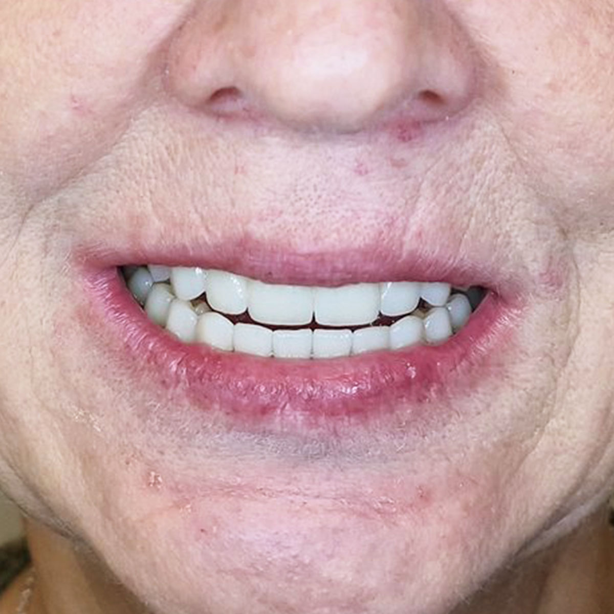 Vitalija - Viso žandikaulio implantacijos atvejis