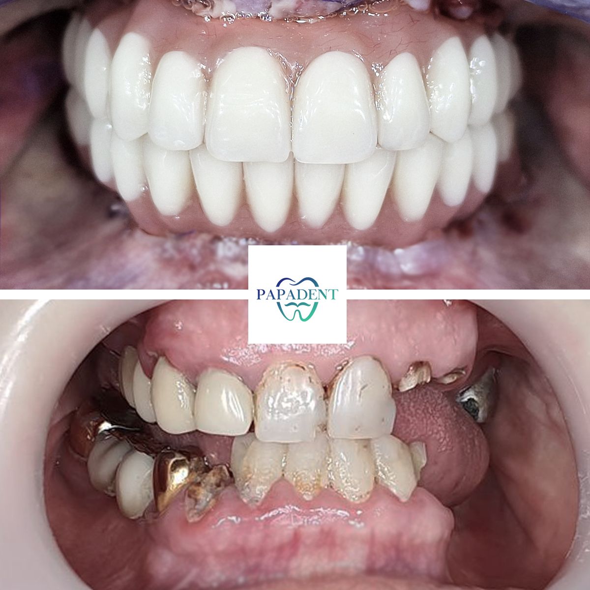 natalija - pries ir po