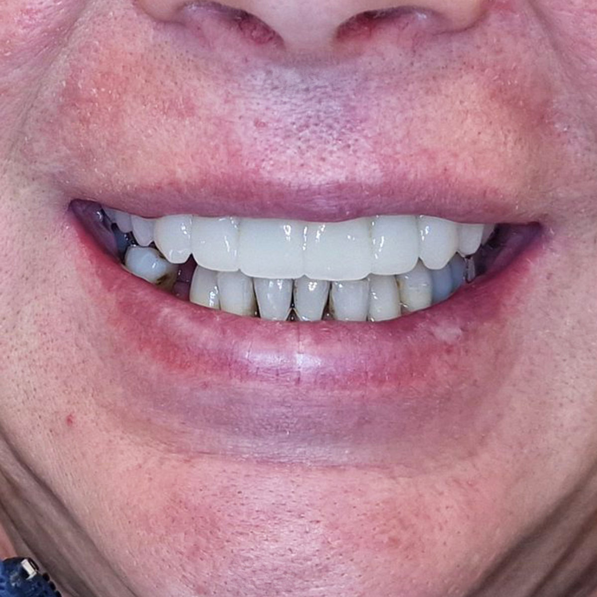 Igoris - Viso žandikaulio implantacijos atvejis