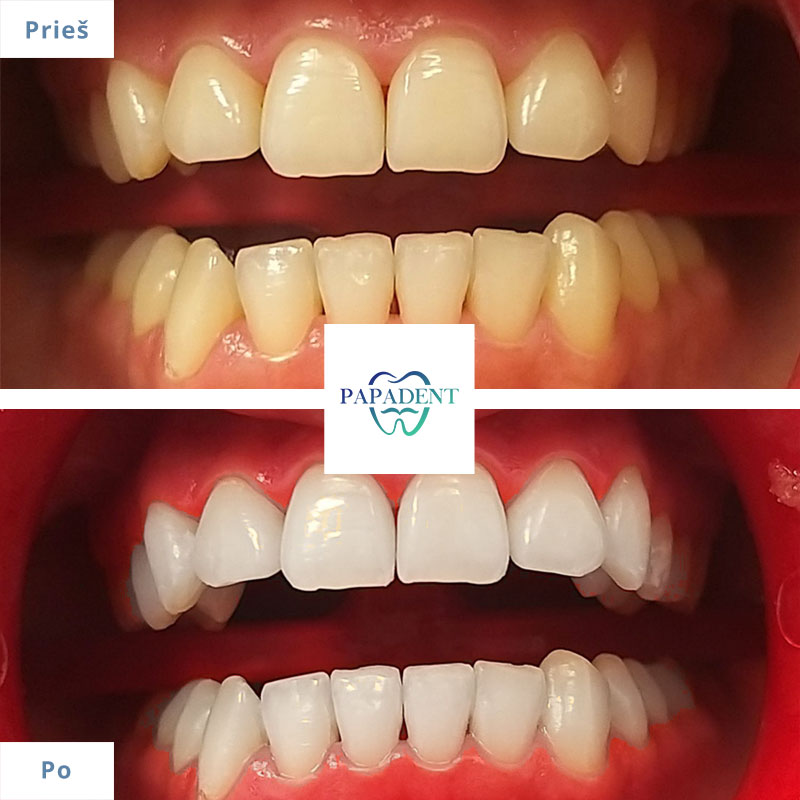 Dantu balinimas Vilniuje