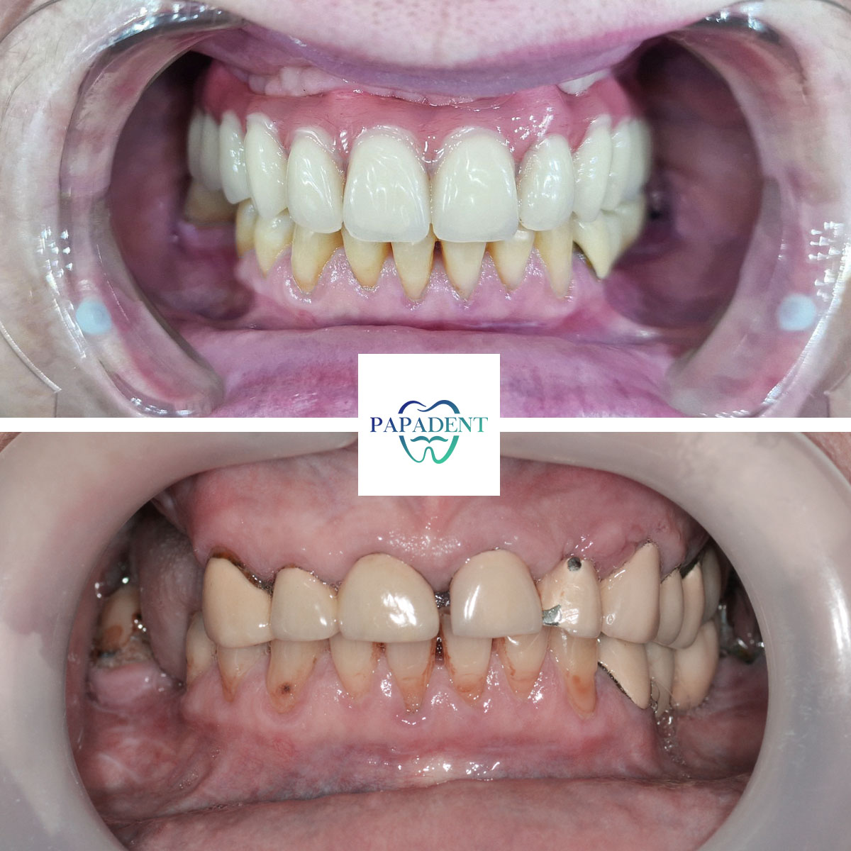 Adelė - All-on-4 dantų protezai - prieš ir po 1