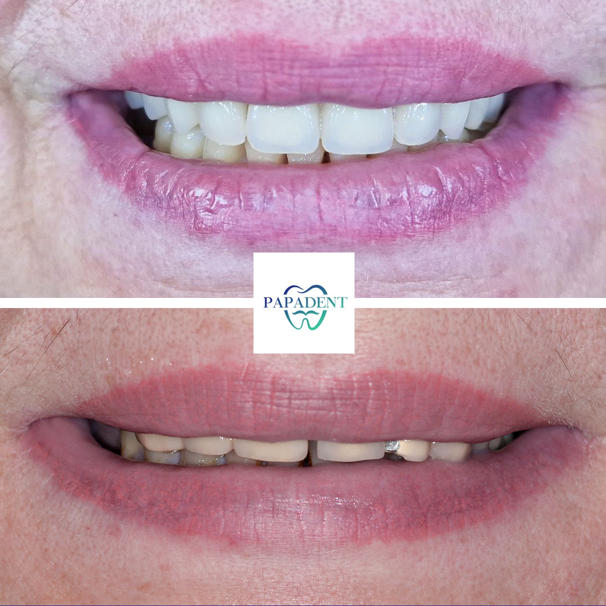 Adelė - Visi dantys ant keturių impantų - Prieš ir po 2