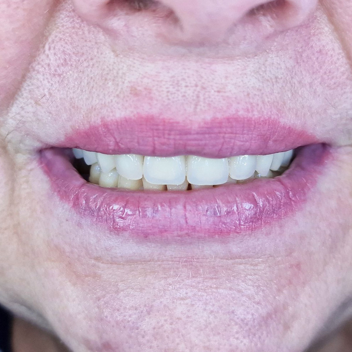 Adelė - Viso žandikaulio implantacijos atvejis