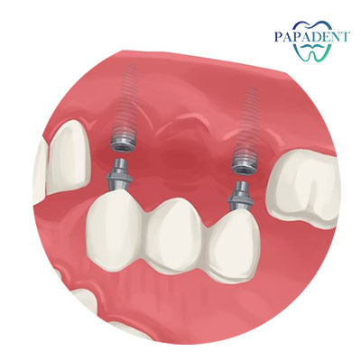 Dantų implantų tiltas