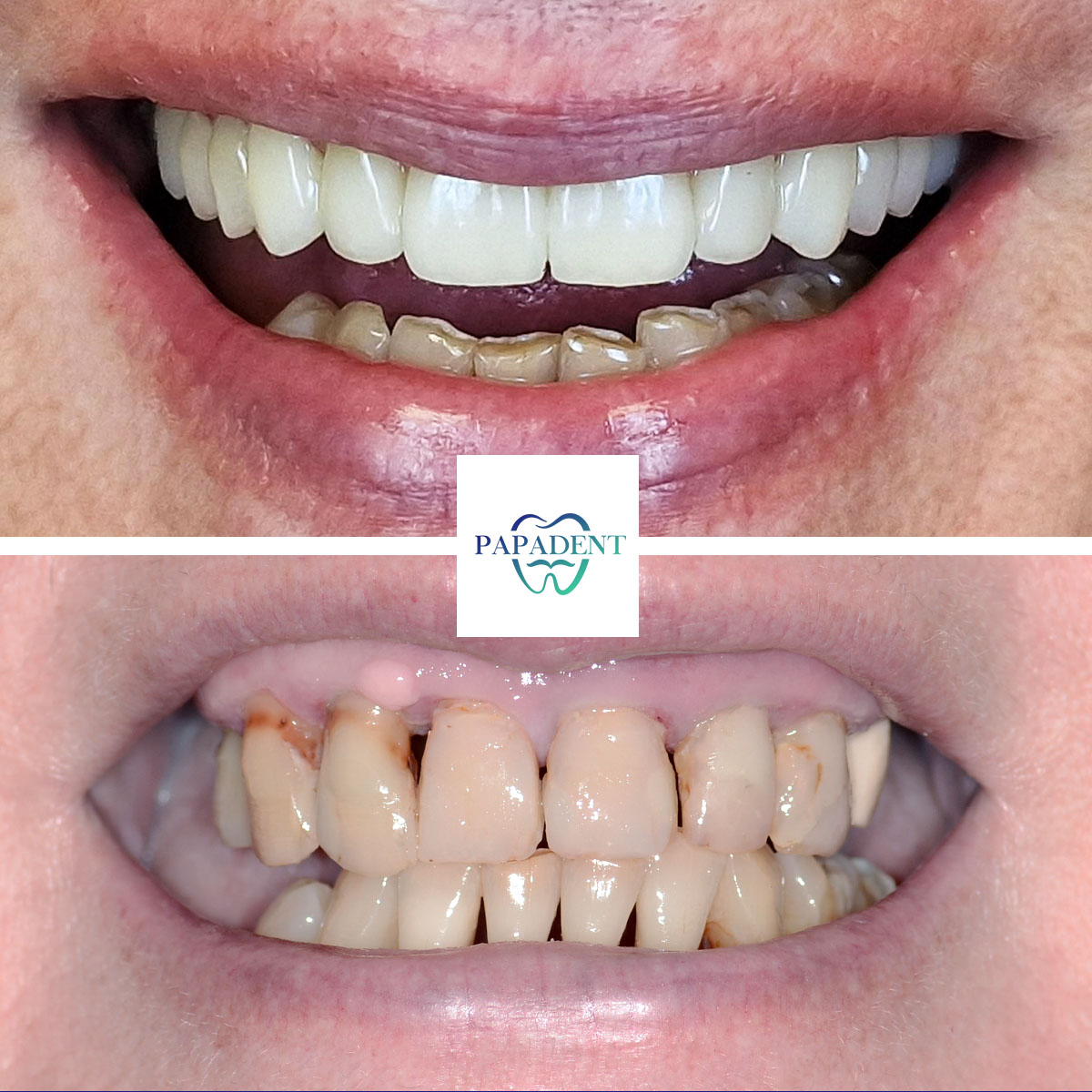 Laima - Visi dantys ant keturių impantų - Prieš ir po 2