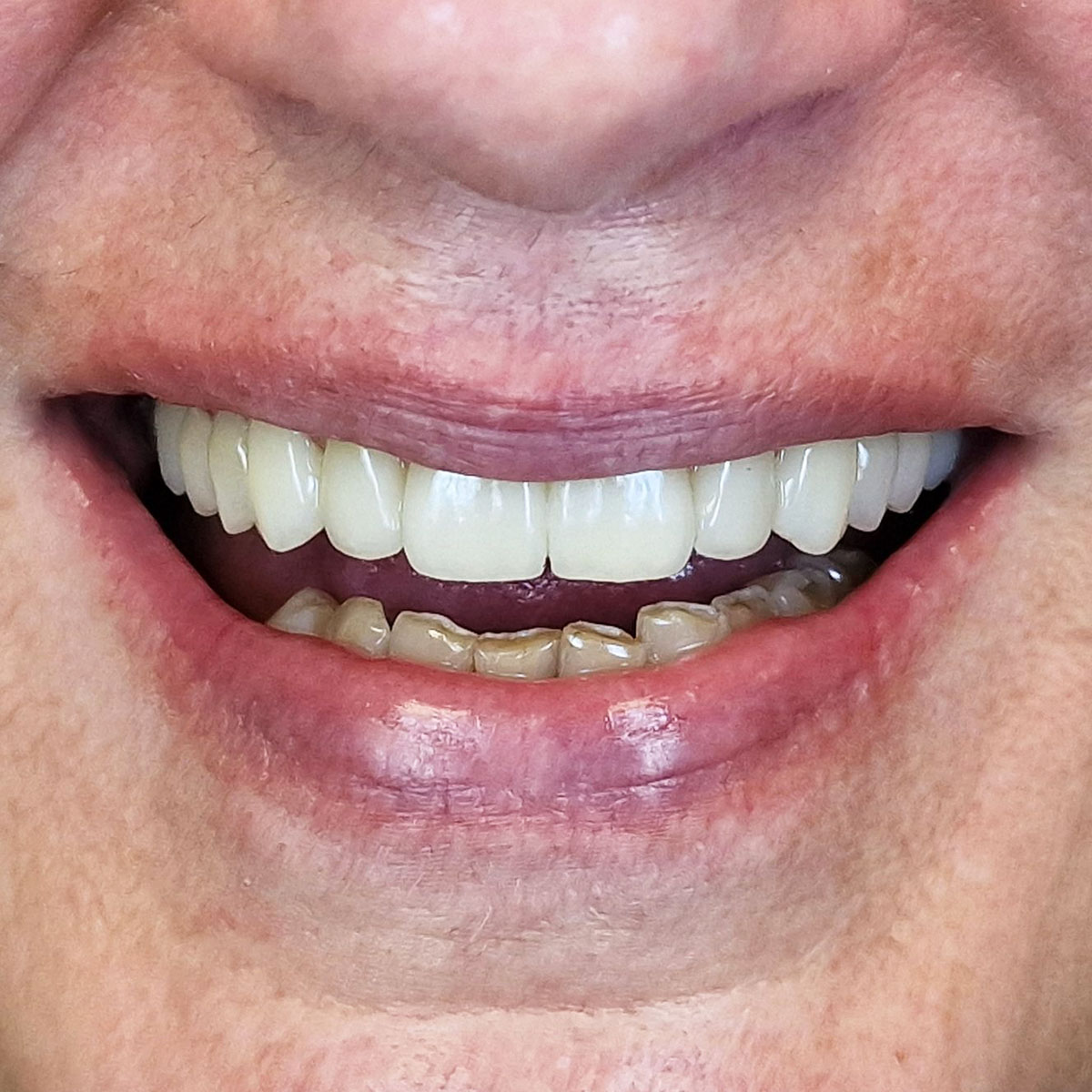 Laima - Viso žandikaulio implantacijos atvejis