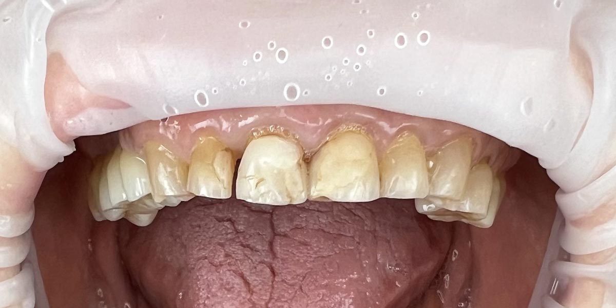 Prie&scaron; - estetinis plombavimas Rima