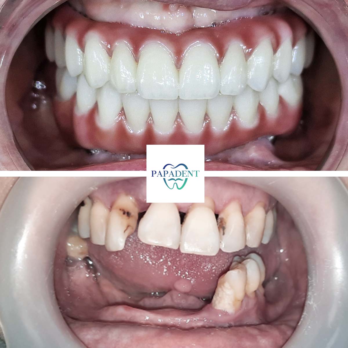 Aldona - All-on-4 dantų protezai - prieš ir po 1