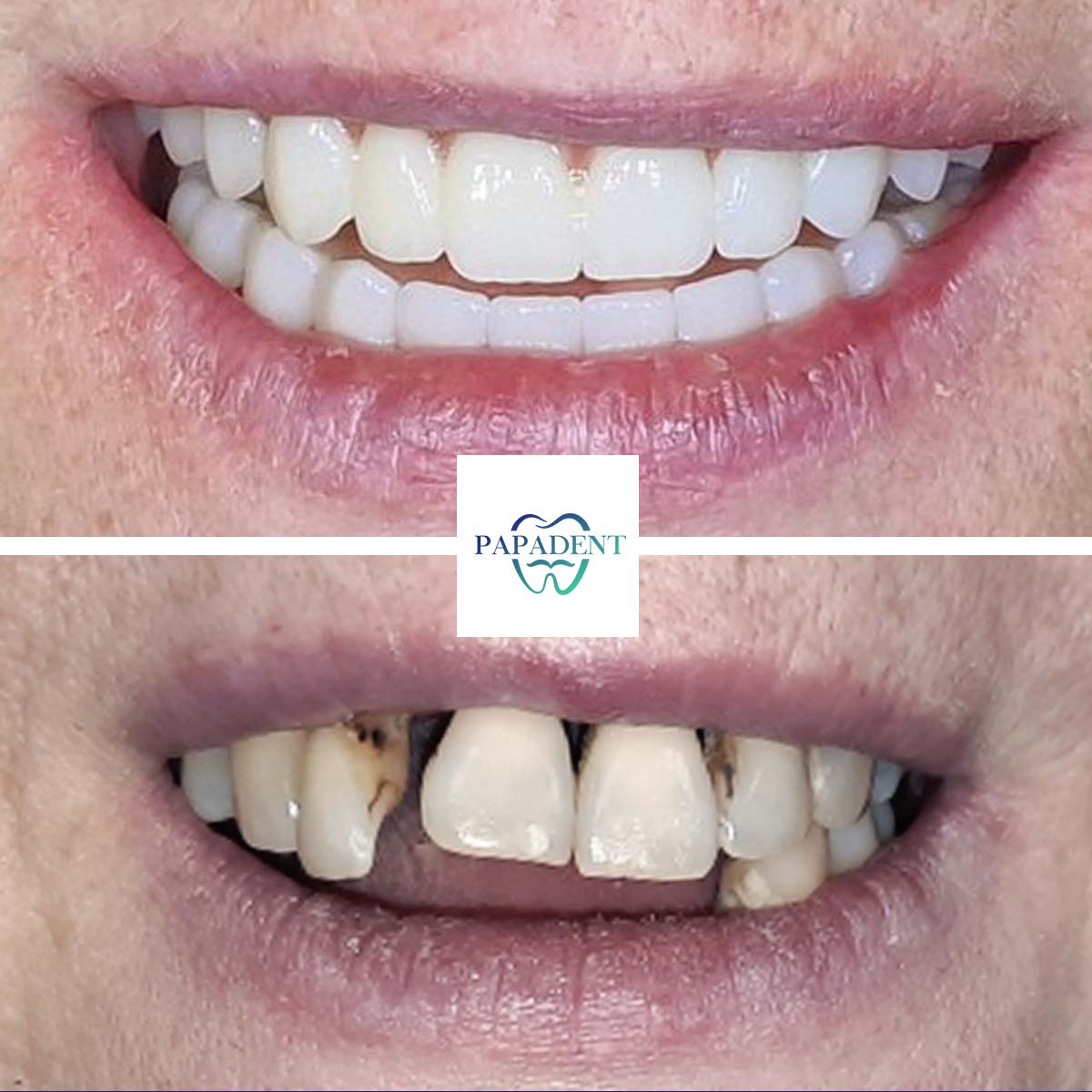 Aldona - Visi dantys ant keturių impantų - Prie&scaron; ir po 2