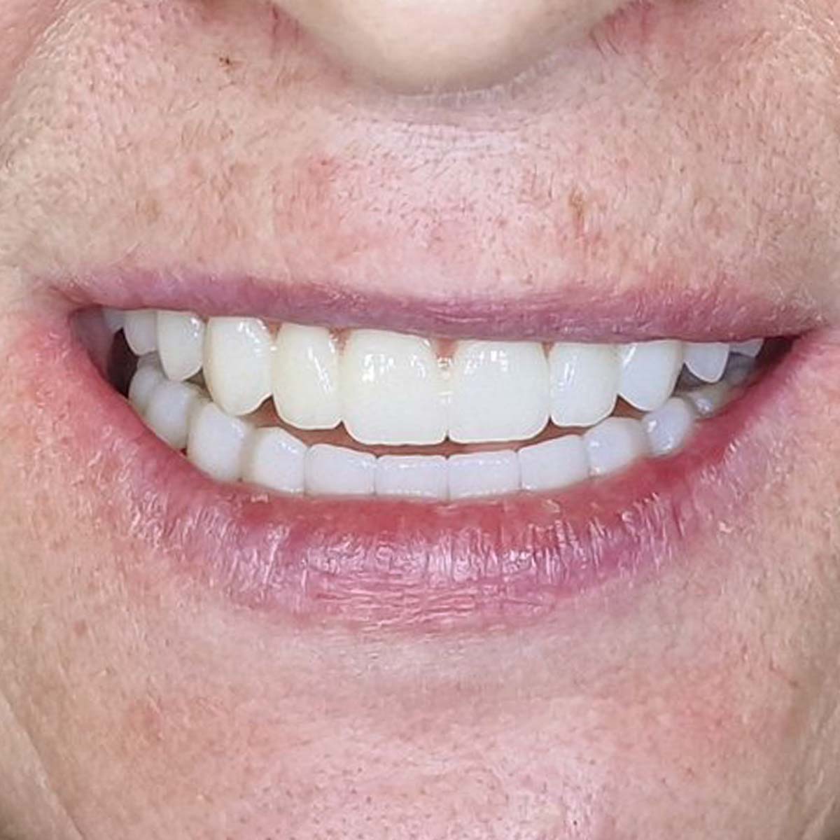 Aldona - Viso žandikaulio implantacijos atvejis