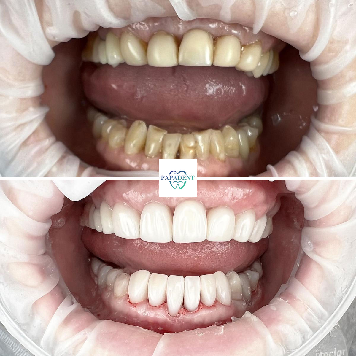 Estetinis dantų restauravimas