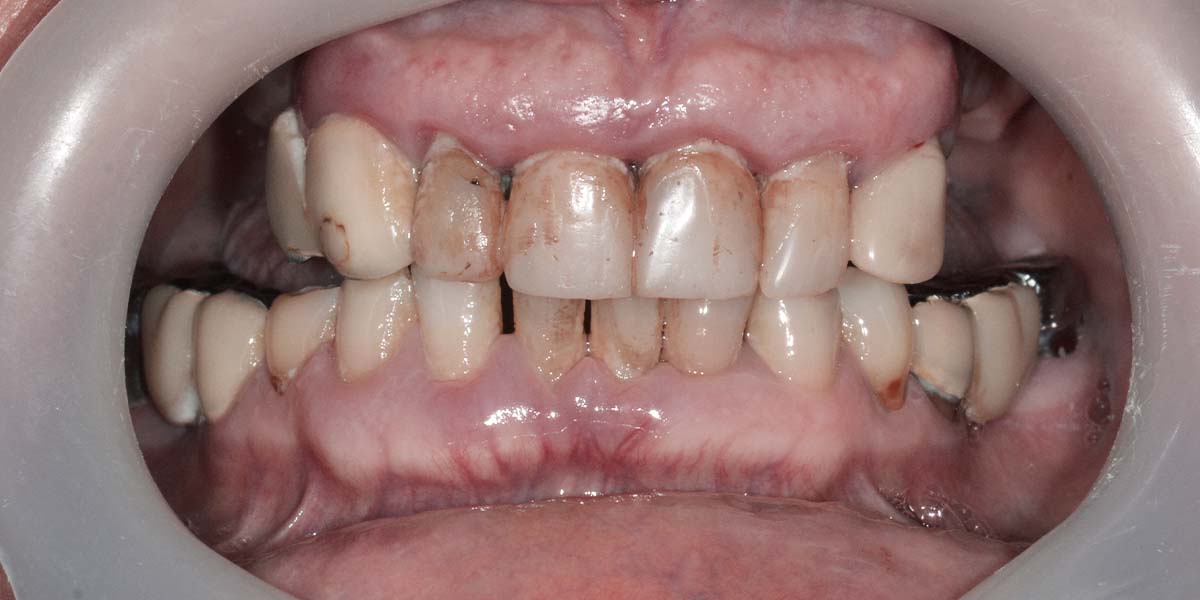 Prieš - Elena - nuolatinis viso žandikaulio metalo-akrilo protezas ant 5 implantų