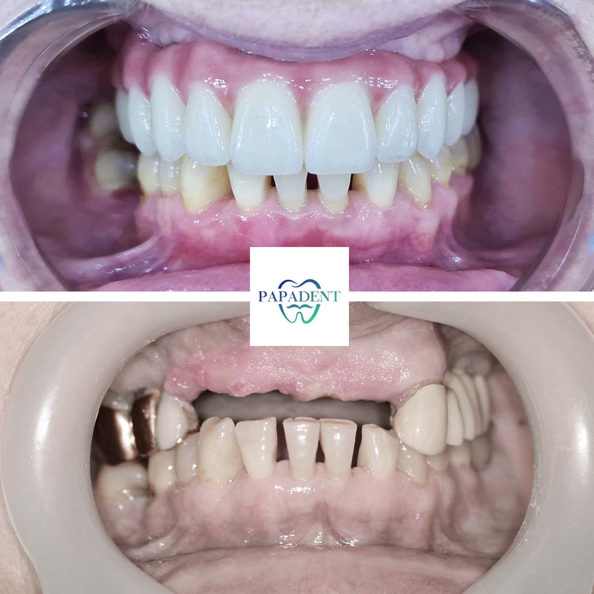 Natalija - All-on-4 dantų protezai - prieš ir po 1