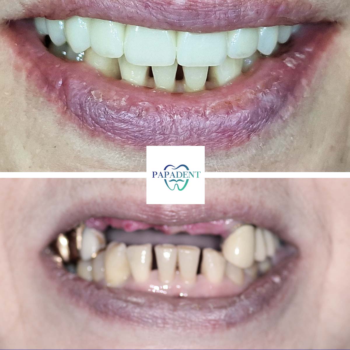 Natalija - Visi dantys ant keturių impantų - Prieš ir po 2