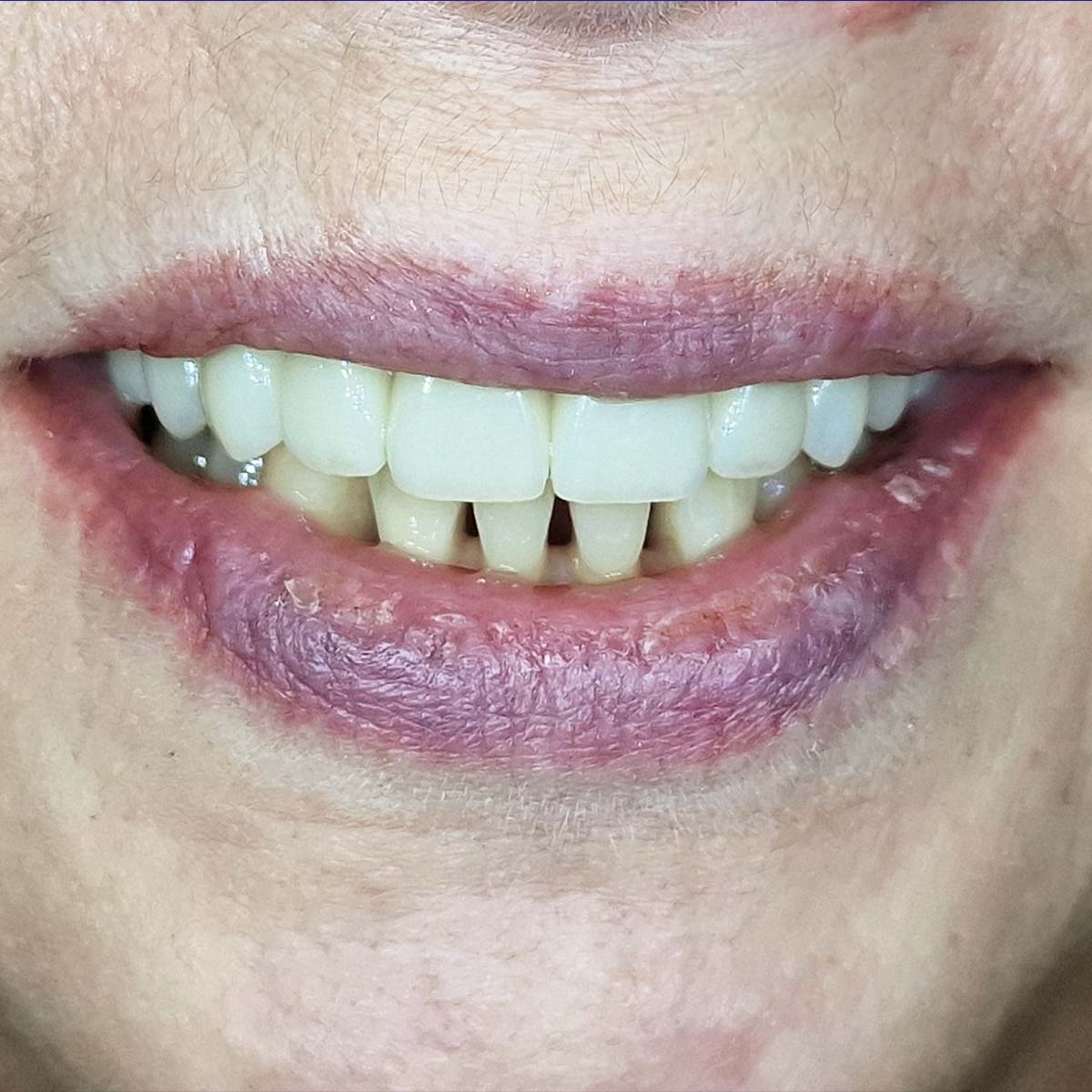 Natalija - Viso žandikaulio implantacijos atvejis