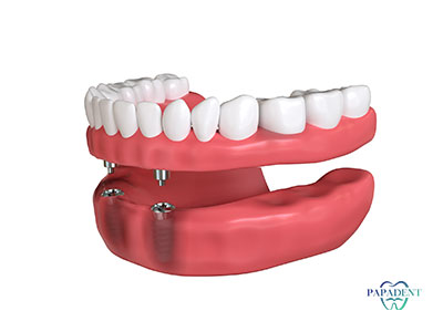 2 implantų i&scaron;imamo protezo fiksacijos kaina