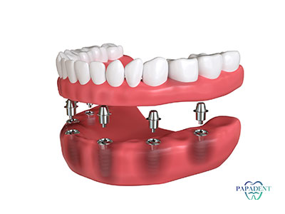 6 dantų implantų kaina