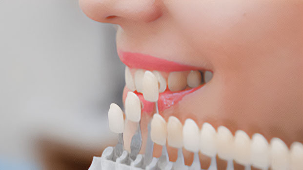 Dantų laminačių parinkimas