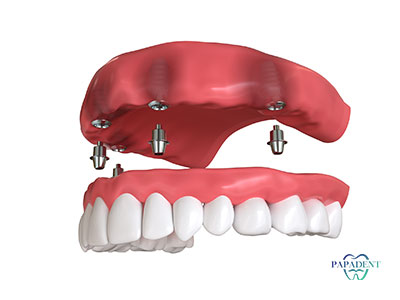 Implantų kaina, kai trūksta visų ar daugelio dantų