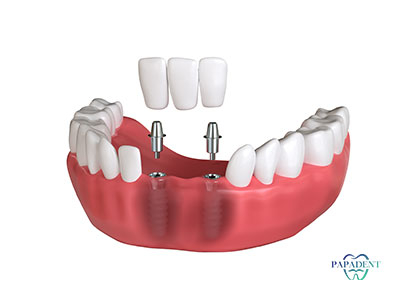 Trijų dantų tilto su dviem implantais kaina Vilniuje