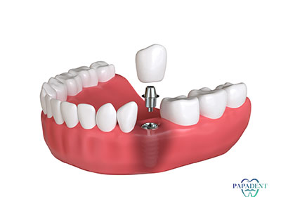 Vieno danties implantas. Kainų palyginimas