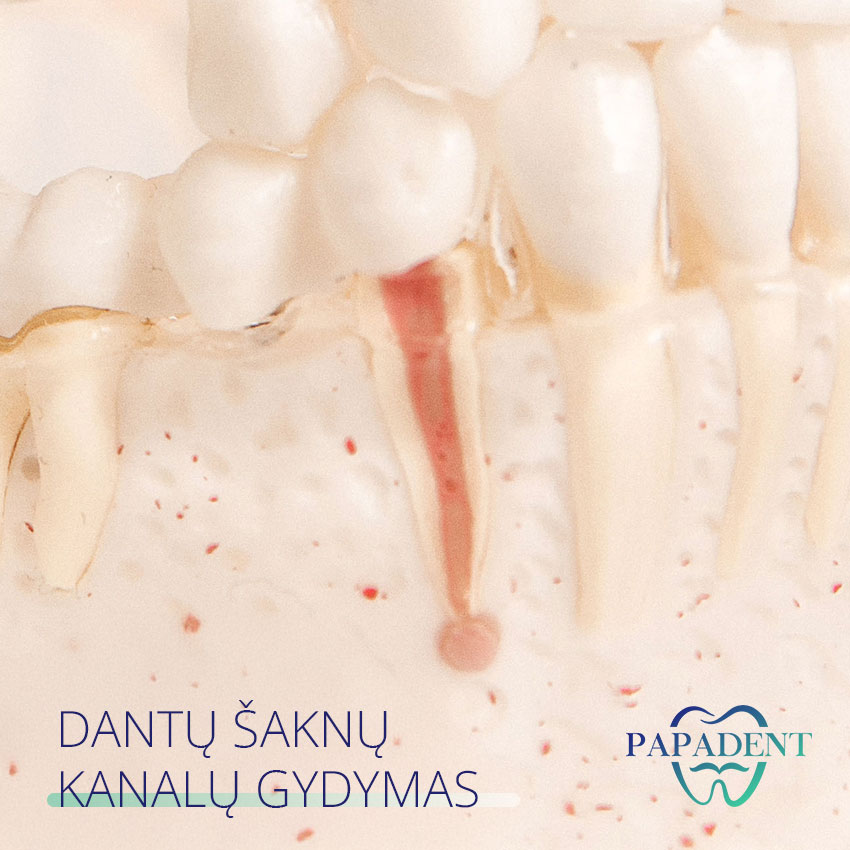 Dantų &scaron;aknų kanalų gydymas - endodontija