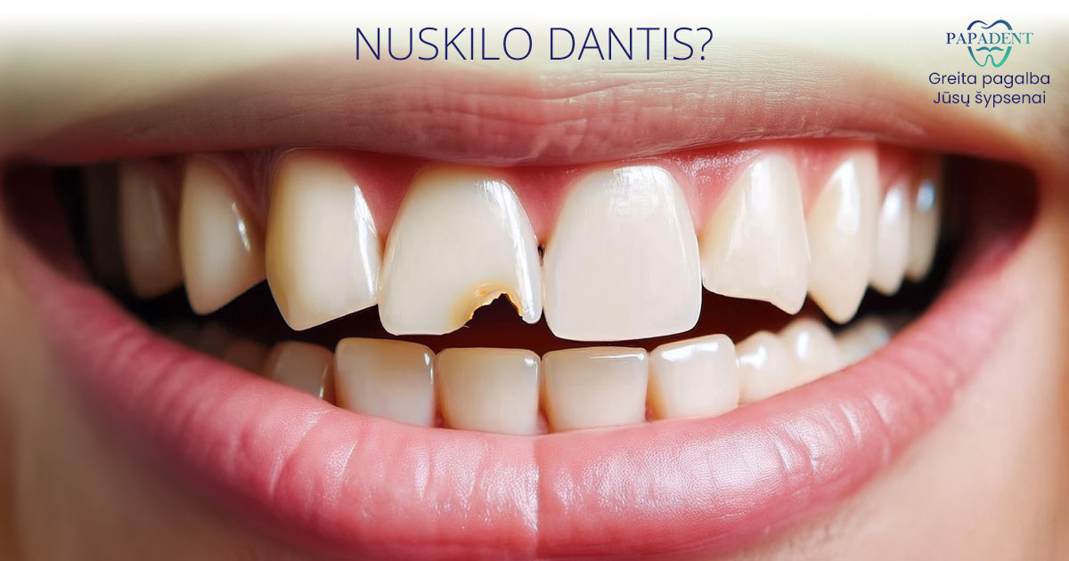 Nuskilo priekinis dantis