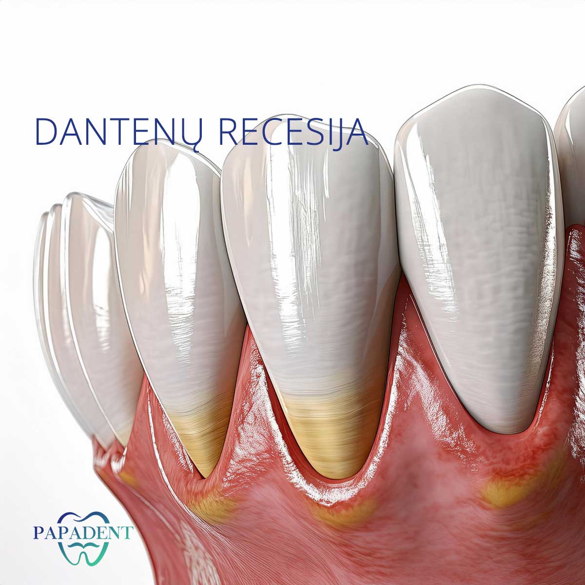 Dantenų recesija
