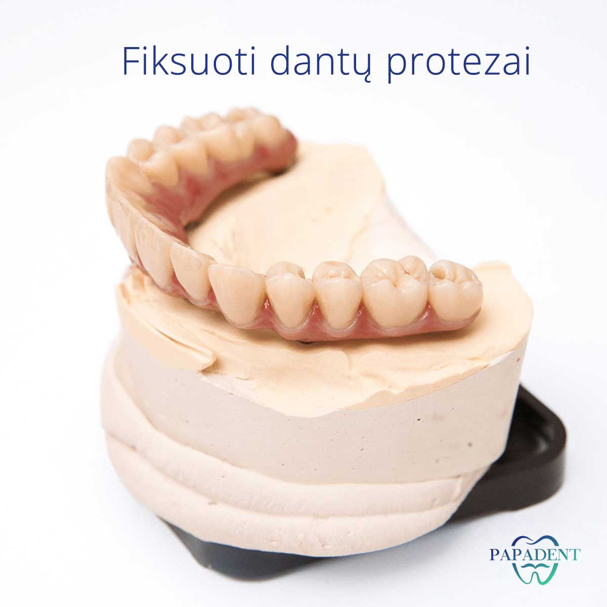 Fiksuoti dantų protezai