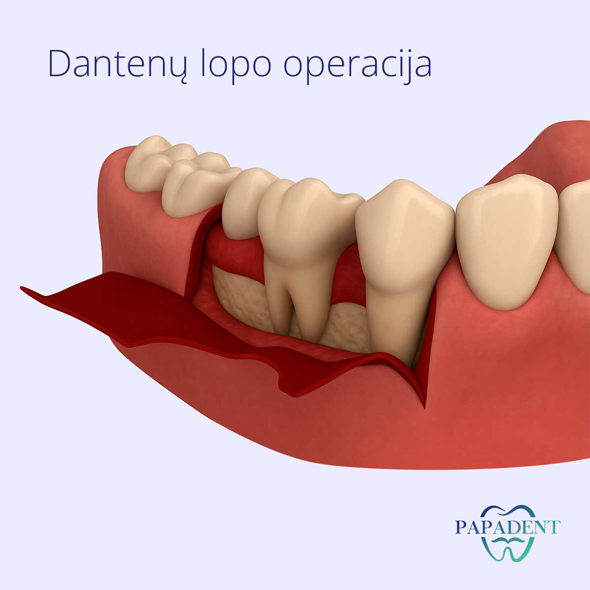 Dantenų lopo operacija ir kainos