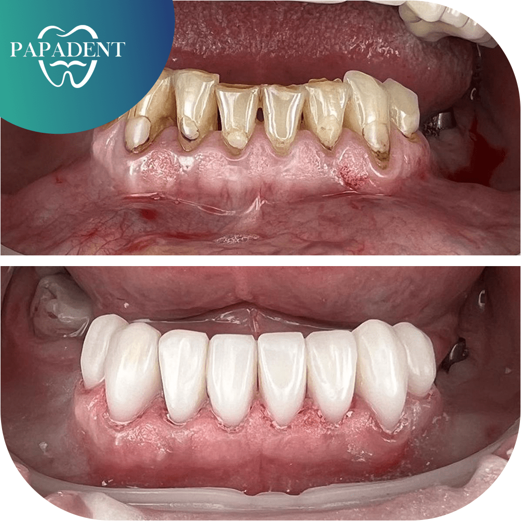 Apatinių dantų estetinis protezavimas