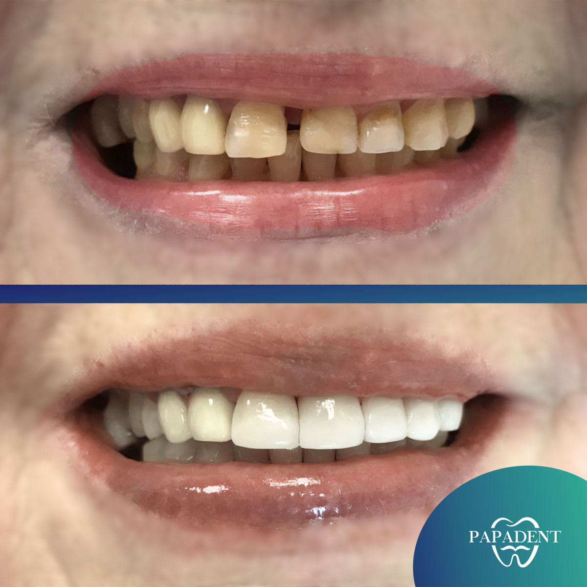 Estetinis plombavimas