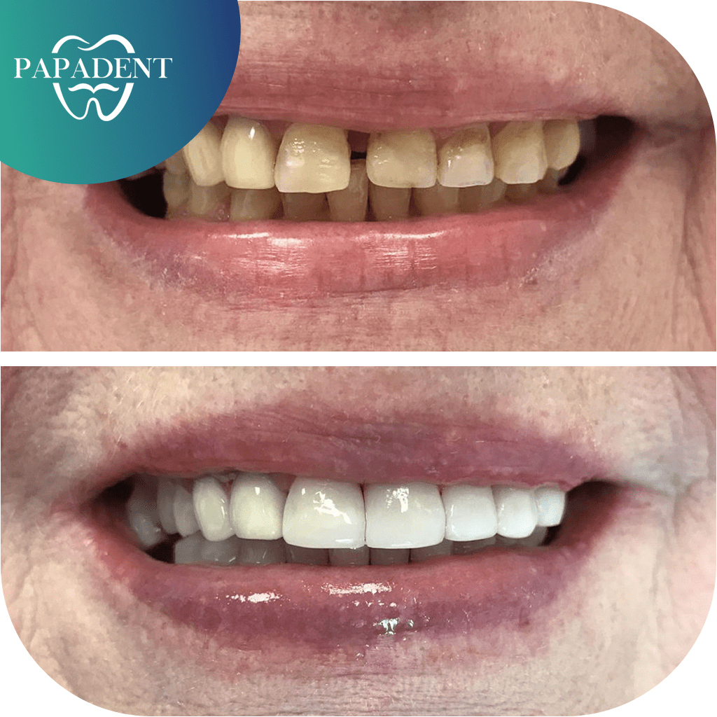 Visų dantų estetinis plombavimas