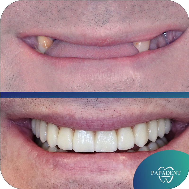 Dantų implantai All-on-4. Prie&scaron; ir po